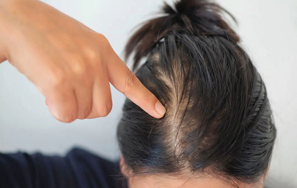  درمان های خانگی  ریزش موی تخمدان پلی کیستیک