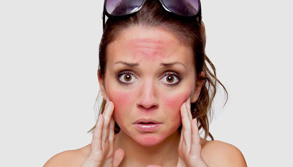 راههای درمان آفتاب سوختگی پوست